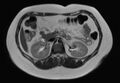 Normal liver MRI with Gadolinium (Radiopaedia 58913-66163 Axial T2 14).jpg