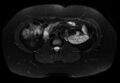 Normal liver MRI with Gadolinium (Radiopaedia 58913-66163 Axial T2 fat sat 11).jpg