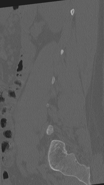 File:Normal lumbar spine CT (Radiopaedia 46533-50986 Sagittal bone window 25).png