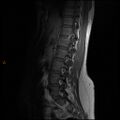 Normal spine MRI (Radiopaedia 77323-89408 Sagittal T1 5).jpg