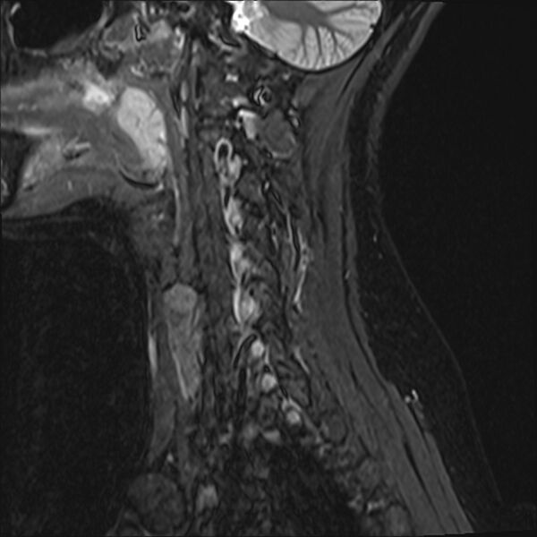 File:Normal trauma cervical spine MRI (Radiopaedia 32130-33071 Sagittal STIR 1).jpg