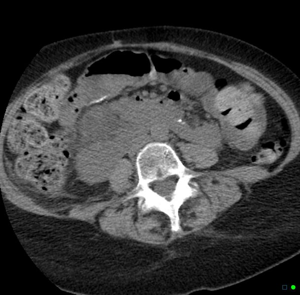 File:Obstructed infected horseshoe kidney (Radiopaedia 18116-17898 non-contrast 19).jpg