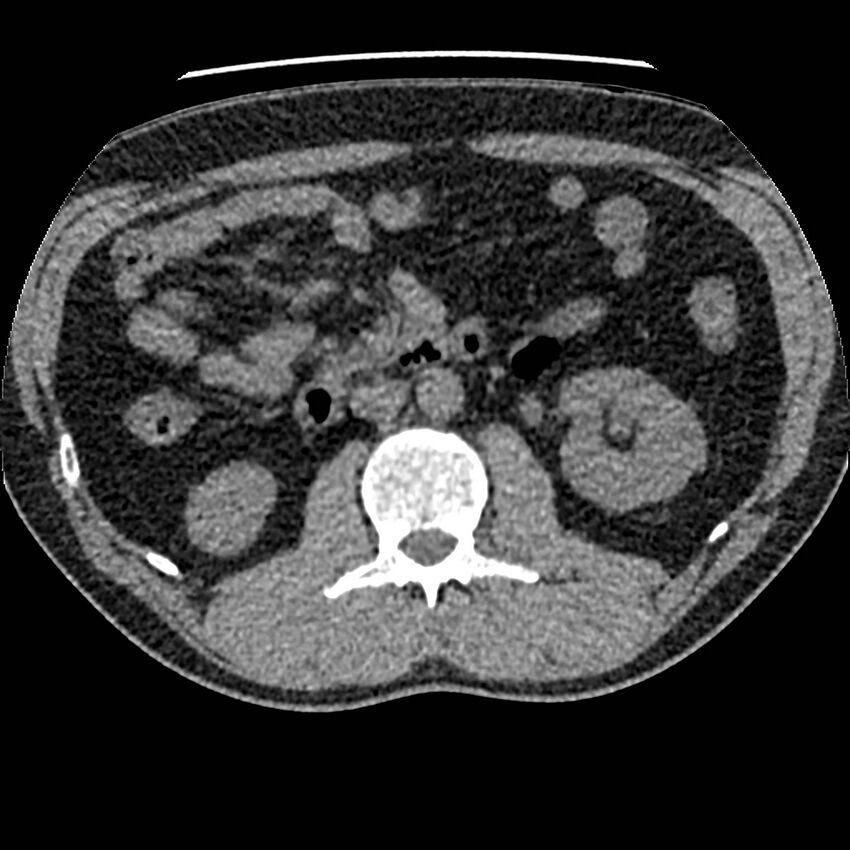 Obstructing ureteric calculus and ureteric anatomy (Radiopaedia 62730-71042 Axial non-contrast 50).jpg