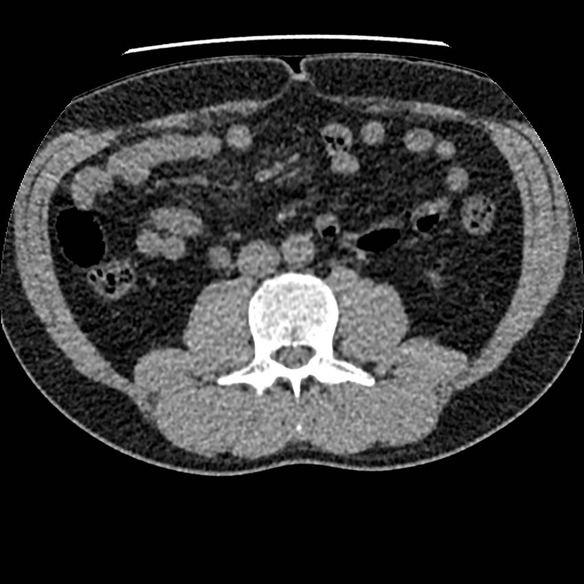 Obstructing ureteric calculus and ureteric anatomy (Radiopaedia 62730-71042 Axial non-contrast 67).jpg