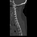 Occipital condyle fracture (Radiopaedia 31755-32691 Sagittal bone window 28).jpg