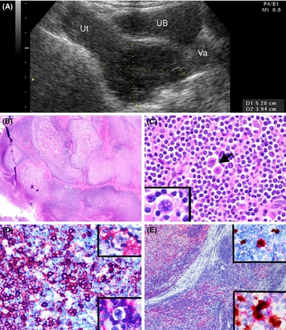 a-e)Clinicopathologic features of cervical nodular lymphocyte-predominant Hodgkin lymphoma
