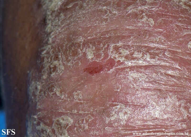 File:Psoriasis (Dermatology Atlas 155).jpg