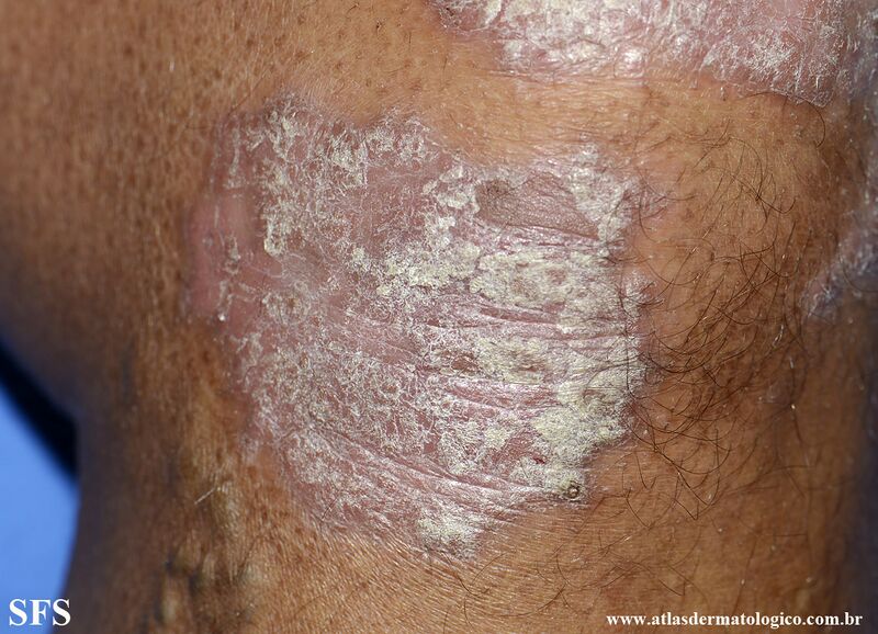 File:Psoriasis (Dermatology Atlas 158).jpg