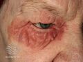 Seborrhoeic dermatitis (DermNet NZ site-age-specific-s-blephseborrh).jpg
