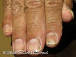 Tinea manuum with infected nails
