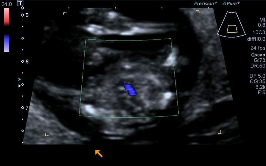 1st trimester nuchal-morphology ultrasound (Radiopaedia 44706-48477 Heart views cine with colour 202).jpg