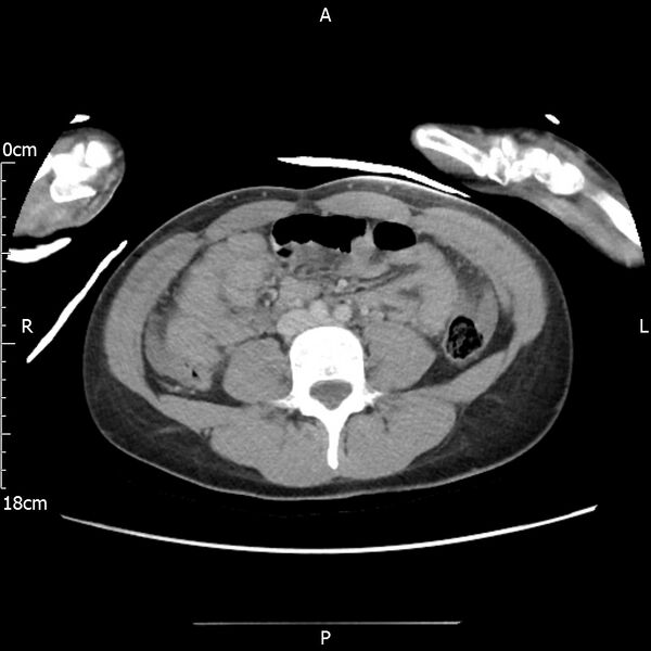 File:AAST grade IV kidney injury with CEUS follow-up (Radiopaedia 72353-82877 Axial C+ portal venous phase 42).jpg