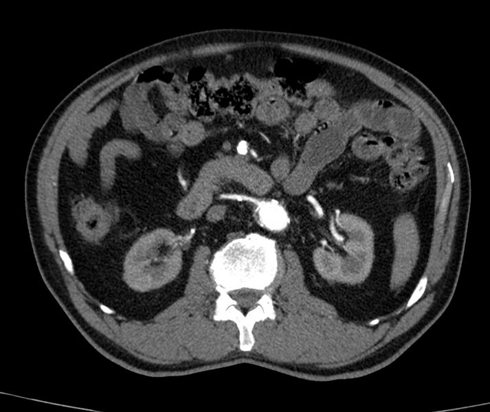 File:Abdominal aortic aneurysm (Radiopaedia 22421-22458 C+ arterial phase 34).jpg