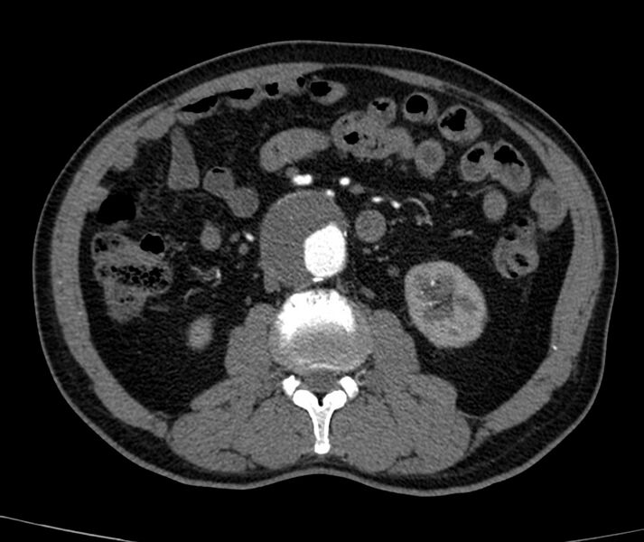 File:Abdominal aortic aneurysm (Radiopaedia 22421-22458 C+ arterial phase 42).jpg