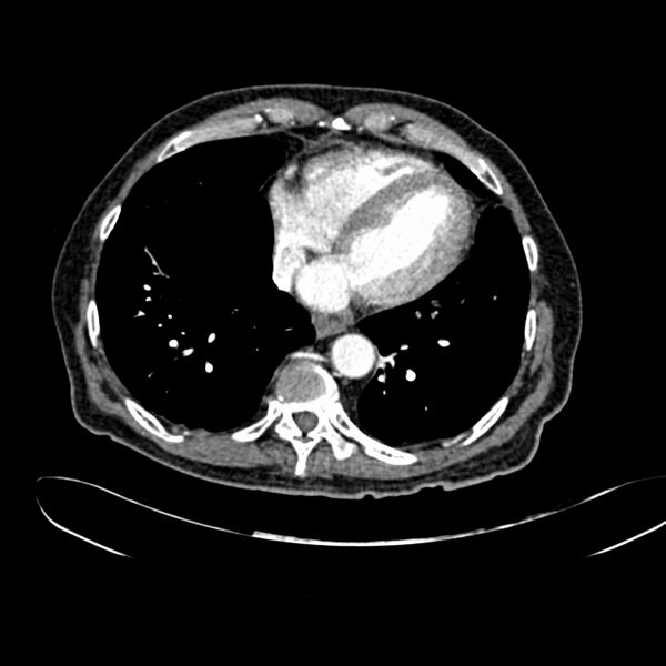 File:Abdominal aortic aneurysm (Radiopaedia 75131-86203 Axial C+ arterial phase 3).jpg