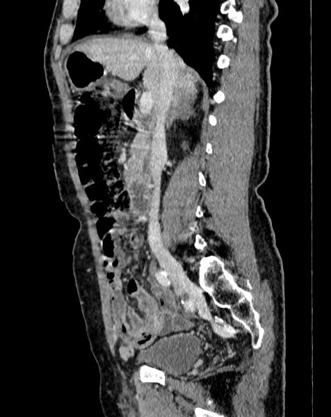 File:Abdominal aortic aneurysm (Radiopaedia 83581-98689 Sagittal C+ portal venous phase 25).jpg