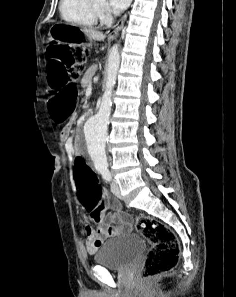 File:Abdominal aortic aneurysm (Radiopaedia 83581-98689 Sagittal C+ portal venous phase 53).jpg
