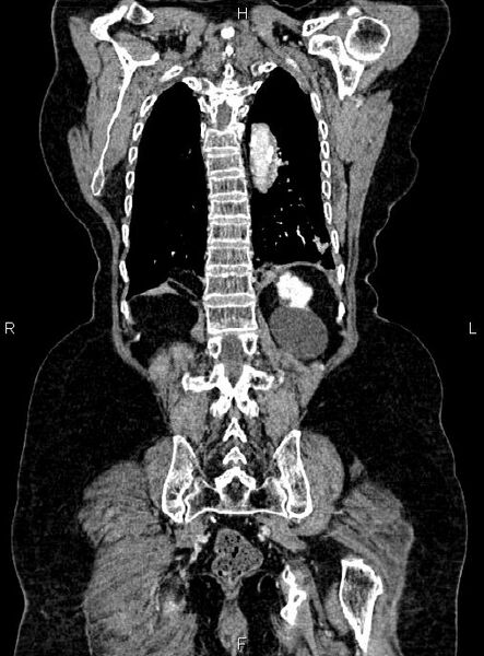 File:Abdominal aortic aneurysm (Radiopaedia 85063-100606 Coronal C+ arterial phase 48).jpg