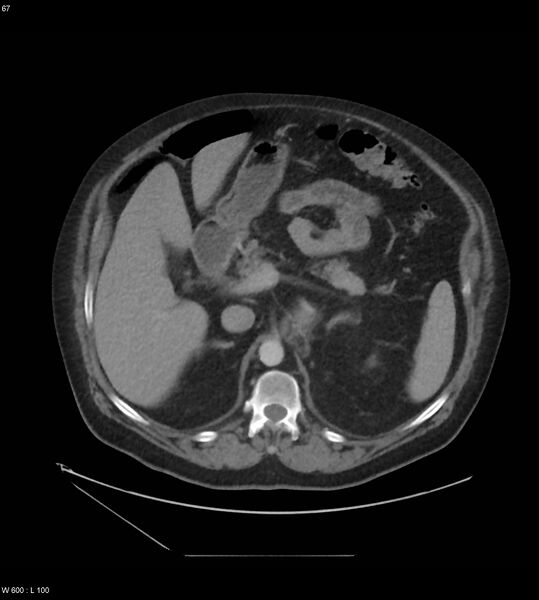 File:Abdominal aortic aneurysm with intramural hematoma then rupture (Radiopaedia 50278-55631 Axial C+ arterial phase 58).jpg