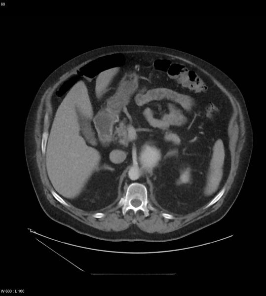 File:Abdominal aortic aneurysm with intramural hematoma then rupture (Radiopaedia 50278-55631 Axial C+ arterial phase 59).jpg