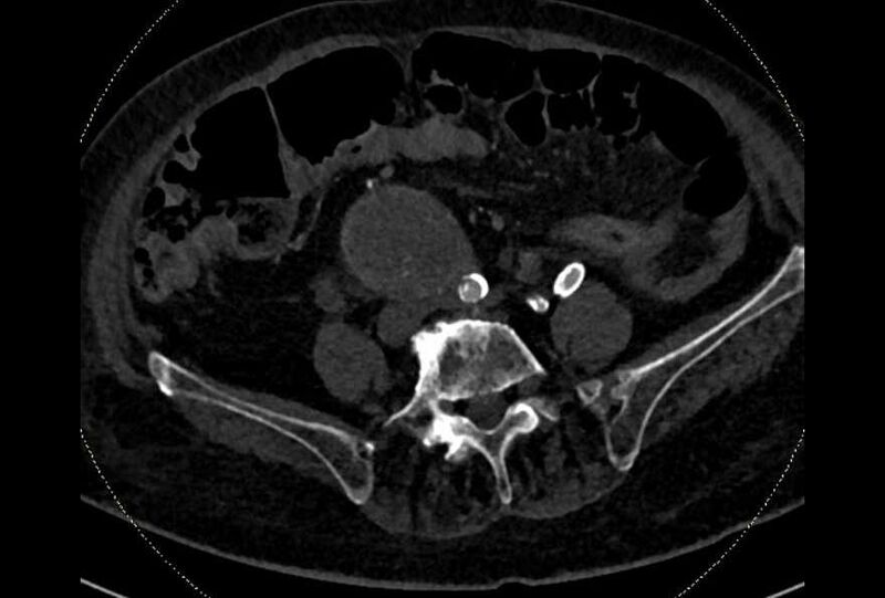 File:Abdominal aortic aneurysm with thrombus fissuration (Radiopaedia 73192-83919 Axial C+ arterial phase 145).jpg