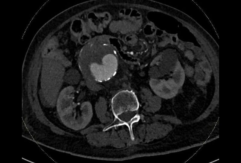 File:Abdominal aortic aneurysm with thrombus fissuration (Radiopaedia 73192-83919 Axial C+ arterial phase 87).jpg