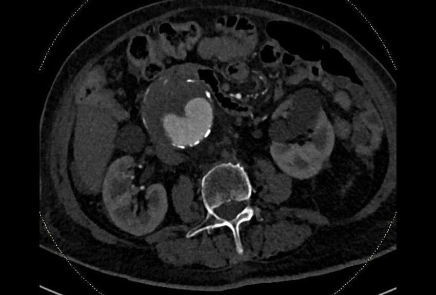 Abdominal aortic aneurysm with thrombus fissuration (Radiopaedia 73192-83919 Axial C+ arterial phase 87).jpg