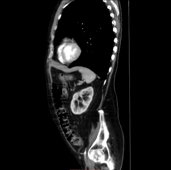 File:Abdominal aortic interposition tube graft and aneurysm thrombosis (Radiopaedia 71438-81857 Sagittal C+ arterial phase 7).jpg