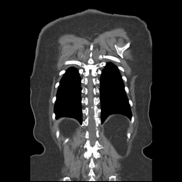 File:Aberrant right subclavian and left vertebral arteries (Radiopaedia 43467-46847 Coronal C+ portal venous phase 75).jpg