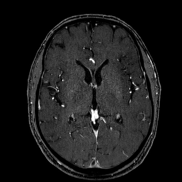 File:Accessory middle cerebral artery (Radiopaedia 73114-83828 Axial MRA 107).jpg