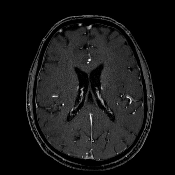 File:Accessory middle cerebral artery (Radiopaedia 73114-83828 Axial MRA 128).jpg