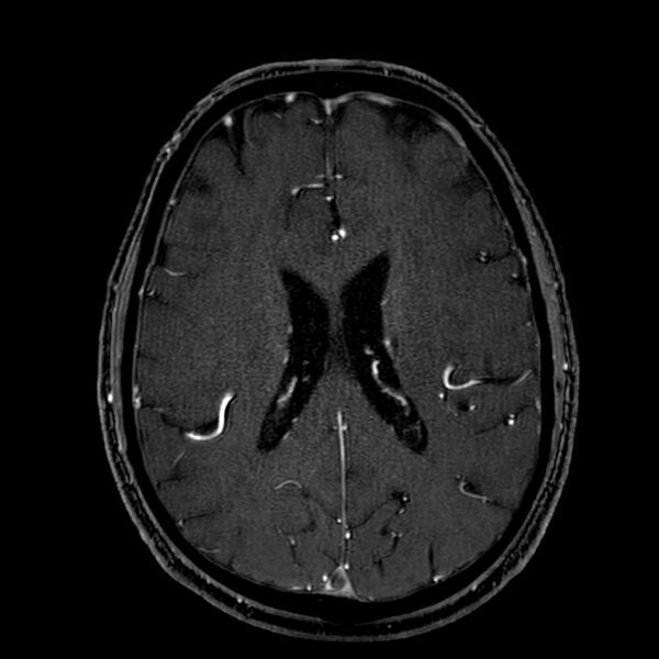 File:Accessory middle cerebral artery (Radiopaedia 73114-83828 Axial MRA 133).jpg