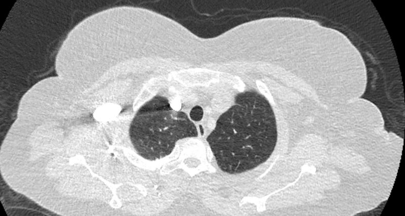 File:Accessory right inferior hepatic vein (Radiopaedia 65245-74259 Axial lung window 5).jpg