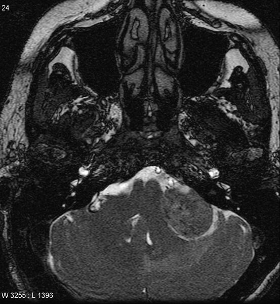 File:Acoustic schwannoma (large with cystic change) (Radiopaedia 5369-7130 Axial T2 1).jpg