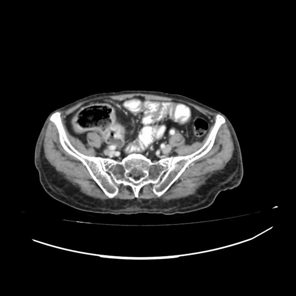 File:Acute-on-chronic Crohn disease with enteroenteric fistula (Radiopaedia 66686-75987 B 48).jpg