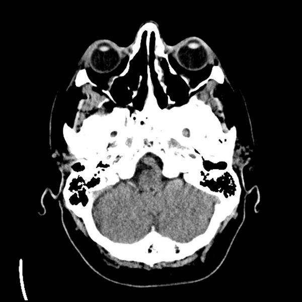 File:Acute A3 occlusion with ACA ischemic penumbra (CT perfusion) (Radiopaedia 72036-82525 Axial non-contrast 7).jpg