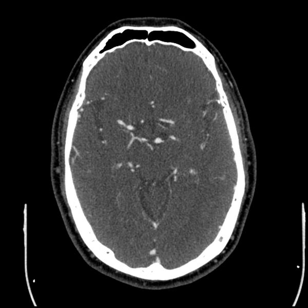 File:Acute A3 occlusion with ACA ischemic penumbra (CT perfusion) (Radiopaedia 72036-82527 Axial C+ arterial phase thins 89).jpg