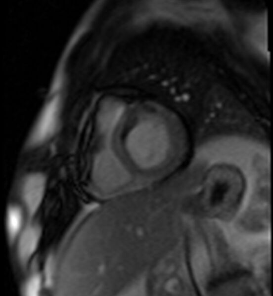File:Acute anteroseptal myocardial infarction (Radiopaedia 68409-77945 Short axis (basal) Perfusion 25).jpg