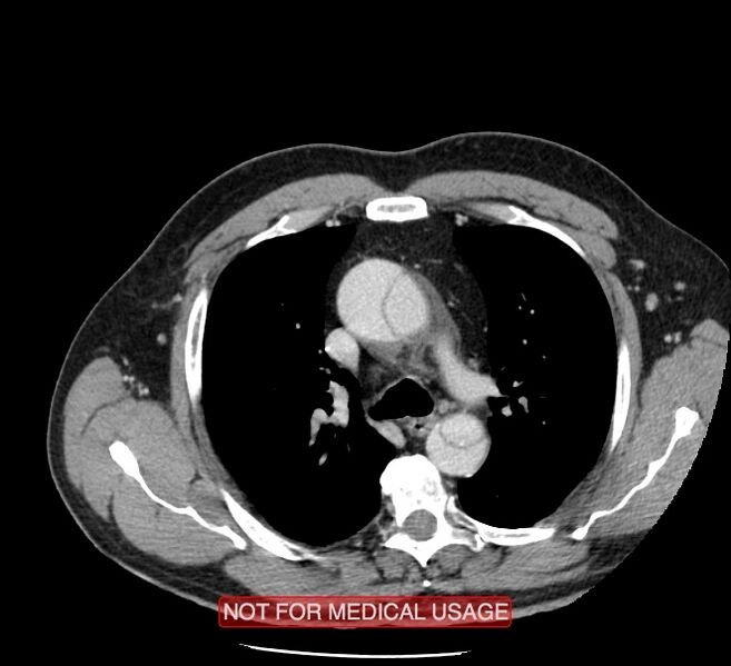 File:Acute aortic dissection - Stanford type A (Radiopaedia 40661-43285 Axial C+ portal venous phase 12).jpg
