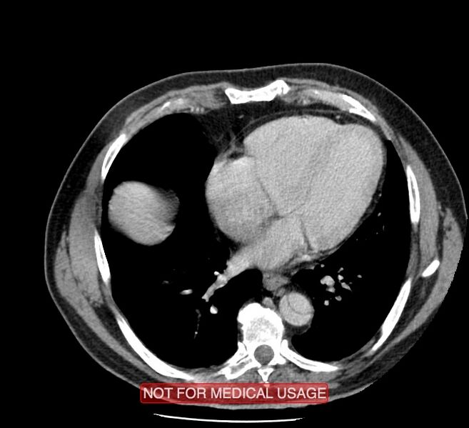 File:Acute aortic dissection - Stanford type A (Radiopaedia 40661-43285 Axial C+ portal venous phase 39).jpg