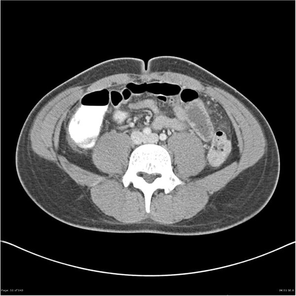 File:Acute appendicitis (Radiopaedia 25364-25615 B 41).jpg