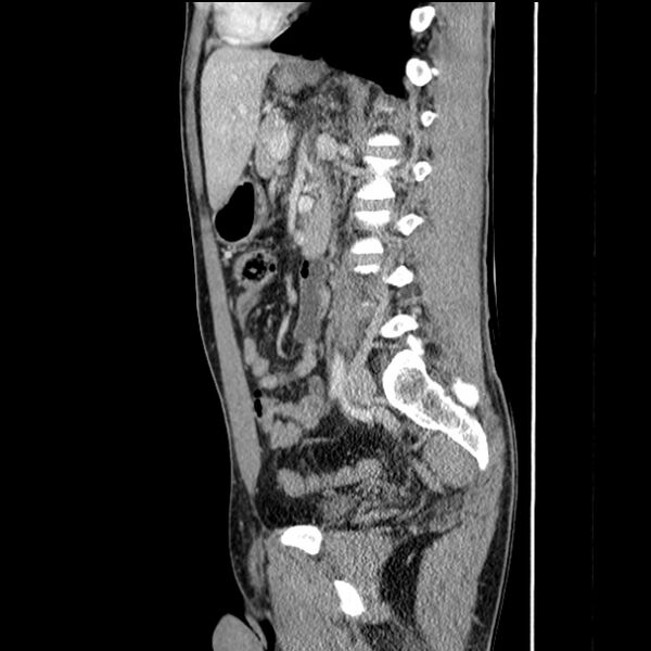 File:Acute appendicitis (Radiopaedia 27049-27227 Sagittal C+ portal venous phase 48).jpg