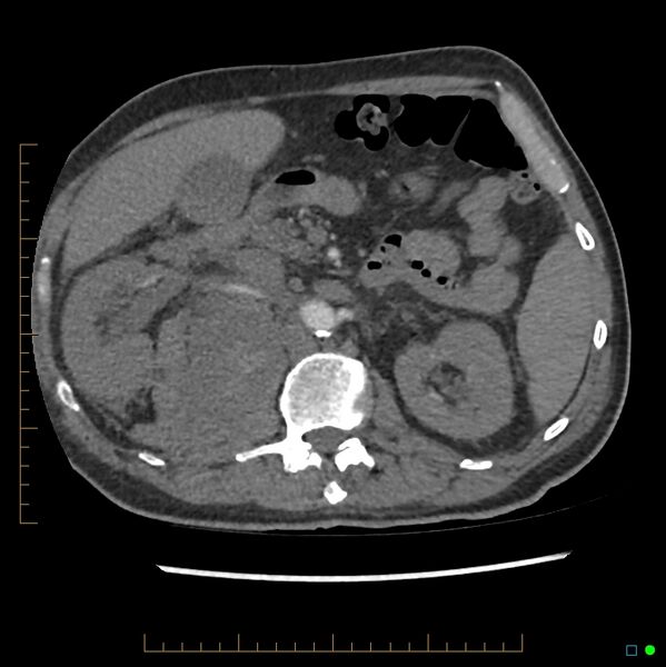 File:Acute hemorrhage into adrenal metastasis from NSCLC (Radiopaedia 43135-46429 Axial C+ CTPA 19).jpg