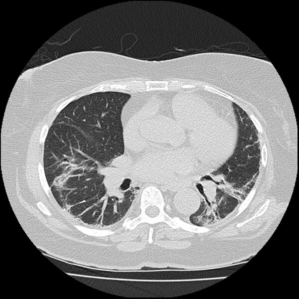 File:Acute interstitial pneumonitis (Radiopaedia 45404-49452 Axial lung window 52).jpg