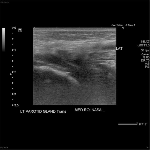 File:Acute left parotid sialadenitis (Radiopaedia 26160-26296 A 7).jpg