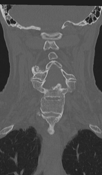 File:Acute on chronic subdural hematoma and thoracic vertebral injury in a multitrauma patient (Radiopaedia 31698-32619 Coronal bone window 32).jpg