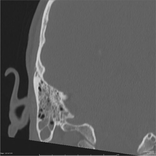 File:Acute otomastoiditis (Radiopaedia 28276-28512 Coronal PTB bone window reformat 50).jpg