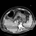 Acute pancreatic necrosis (Radiopaedia 13560-18502 Axial C+ portal venous phase 10).jpg