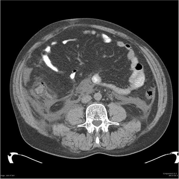 File:Acute pancreatitis (Radiopaedia 19135-19116 Axial non-contrast 33).jpg