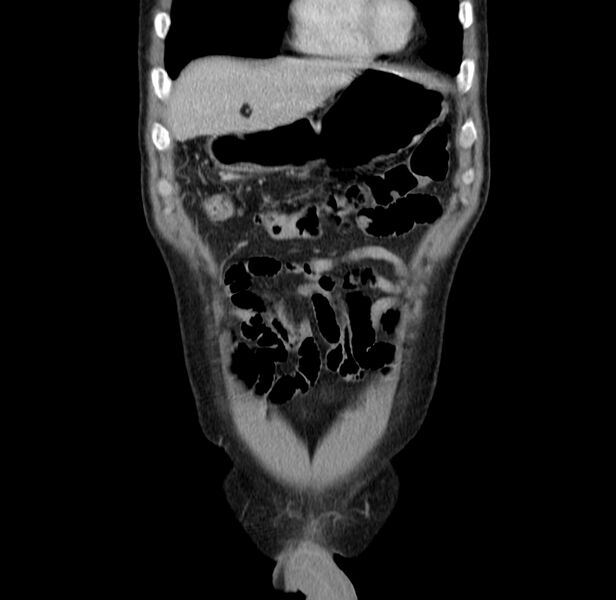 File:Acute pancreatitis (Radiopaedia 22572-22596 Coronal C+ portal venous phase 12).jpg